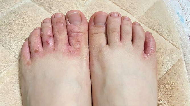 腳氣爛腳趾縫癢潰爛的治療方法，全面解析與應(yīng)對(duì)策略，腳氣爛腳趾縫癢潰爛全面解析與治療策略