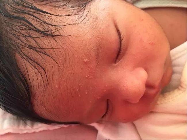 脂溢性皮炎的治療方法，全面解析最佳策略，脂溢性皮炎全面解析最佳治療方法策略